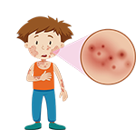 Psoriasis