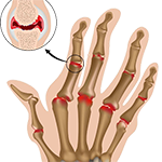 Arthritis