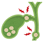 Gallbladder Stone