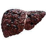 Liver Cirrhosis