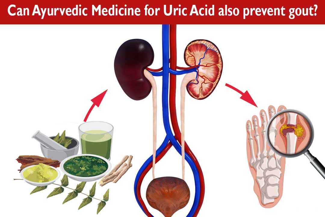 Can Ayurvedic Medicine for Uric Acid also prevent gout?