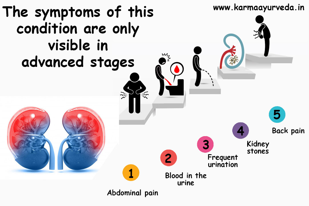 Can Ayurvedic Remedy To Shrink Kidney Cysts Prevent Damage?