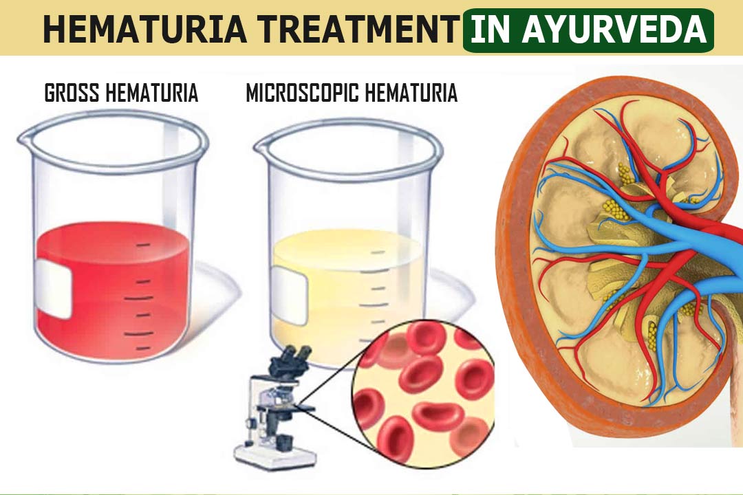 Hematuria: Cure with Ayurveda, symptoms, causes, treatment