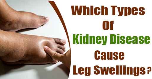 Which types of kidney disease cause leg swellings