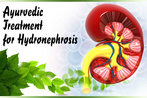 Hydronephrosis | Ayurvedic Treatment For Hydronephrosis