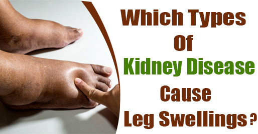 kidney disease cause Leg swellings