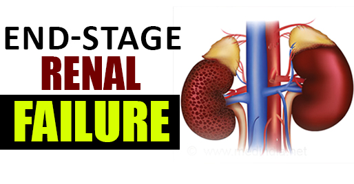 End-stage renal failure