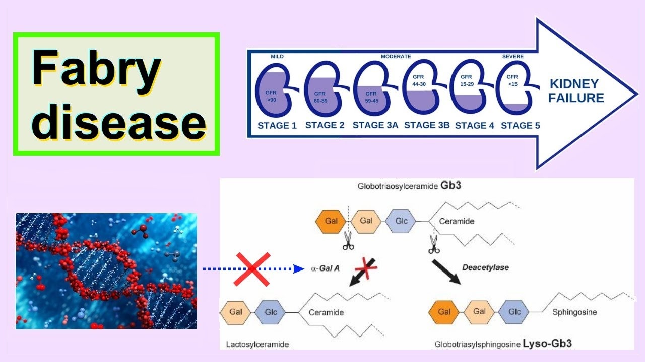 fabry-kidney-disease