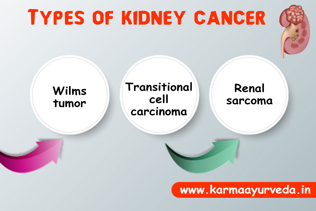Kidney Cancer Treatment and Prognosis