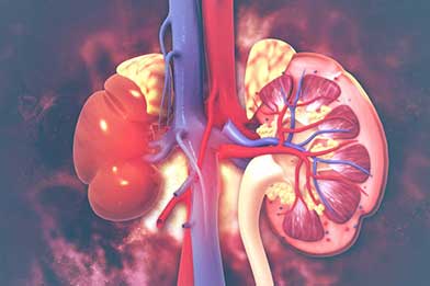Nephrotic Syndrome effected Kidney
