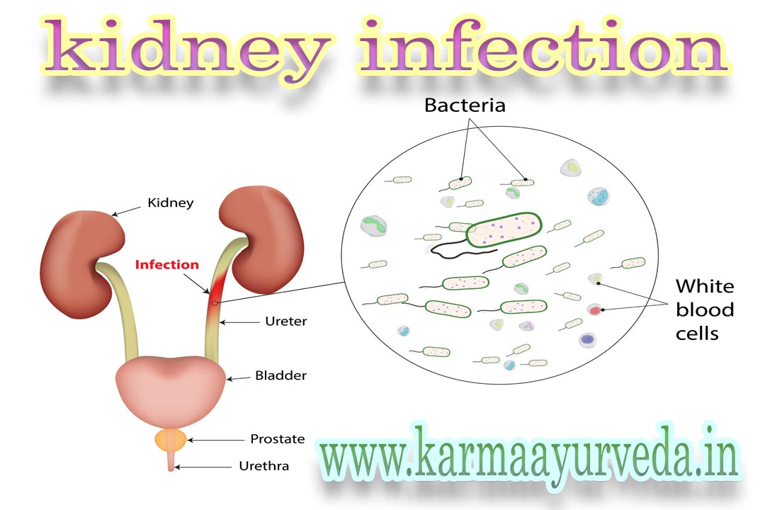 Ayurvedic Kidney Infection