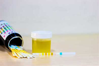 Proteinuria Kidney Disease treatment by Karma ayurveda