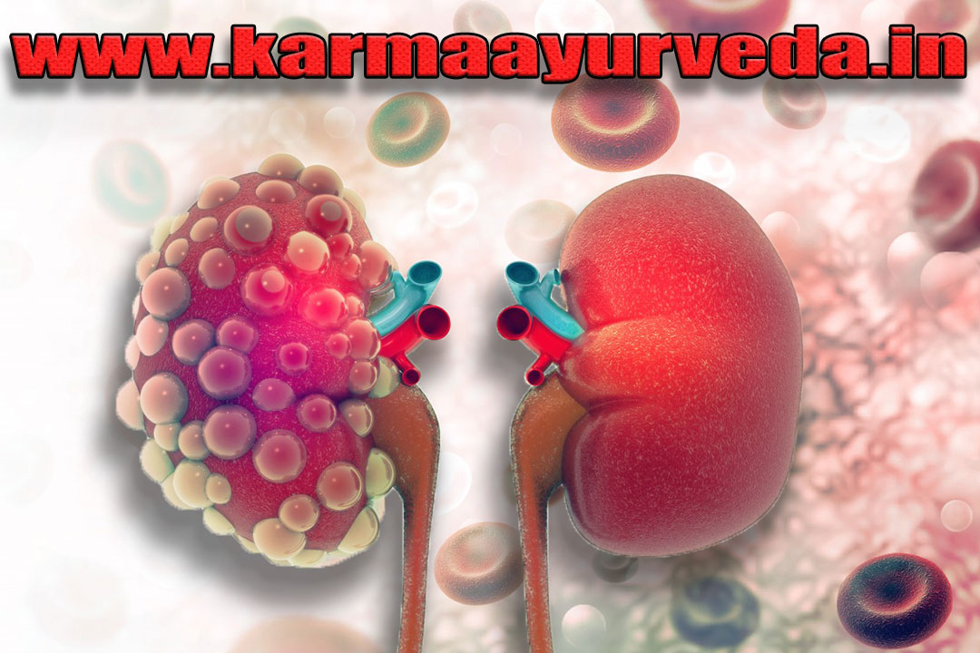 Kidney Failure Treatment Uttar Pradesh