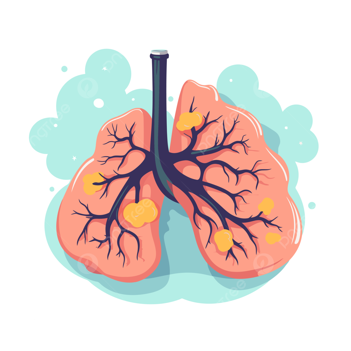 lung cancer